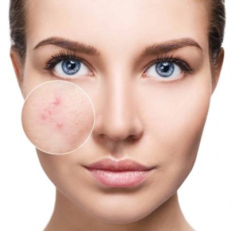 acne-face-treatment-470x400